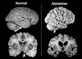 Alzheimer 3